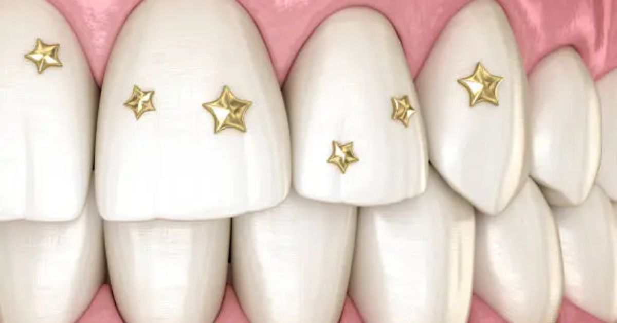 stars with dental implants